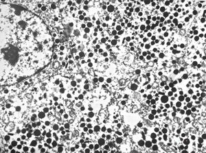 F, 72y. | carcinoid … metastasis to lymphonode